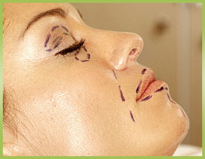 Anti-aging: How to Know If You Make a Good Candidate for a Facelift