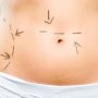 Naperville Tackles The Tummy Tuck